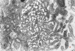 M,66y. | bone marrow - tubuloreticular complex M,66y. | bone marrow - tubuloreticular complex